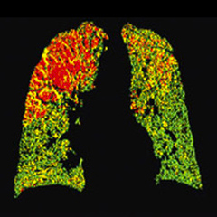 Lungs with green, yellow and red areas.