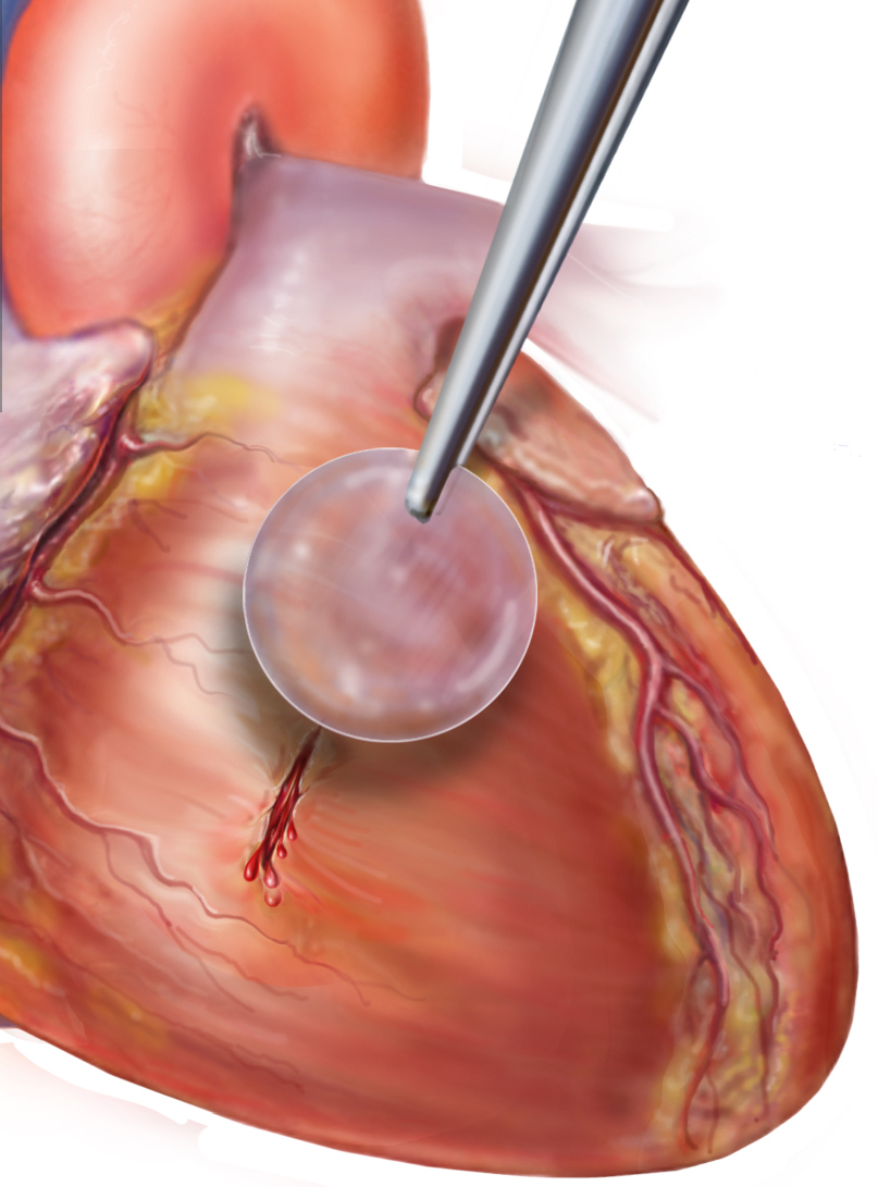 Nature-Inspired Surgical Glue Mends Hearts