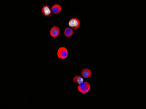 Tumor cells color red and blue Tumor cells color red and blue.