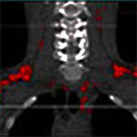 Brown fat in neck and upper back region Brown fat in neck and upper back region.