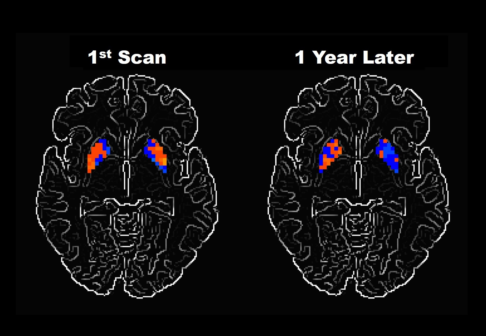 Brain scans taken a year apart show different levels of activity in certain areas.