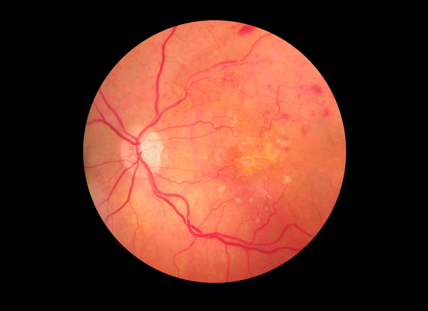 Medical photo of retinopathy