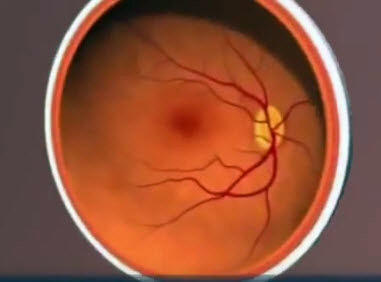 Screenshot of eye showing yellowish deposit under the retina and prominent blood vessels.