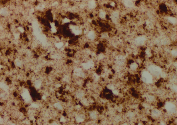 Brain tissue from person with sporadic CJD