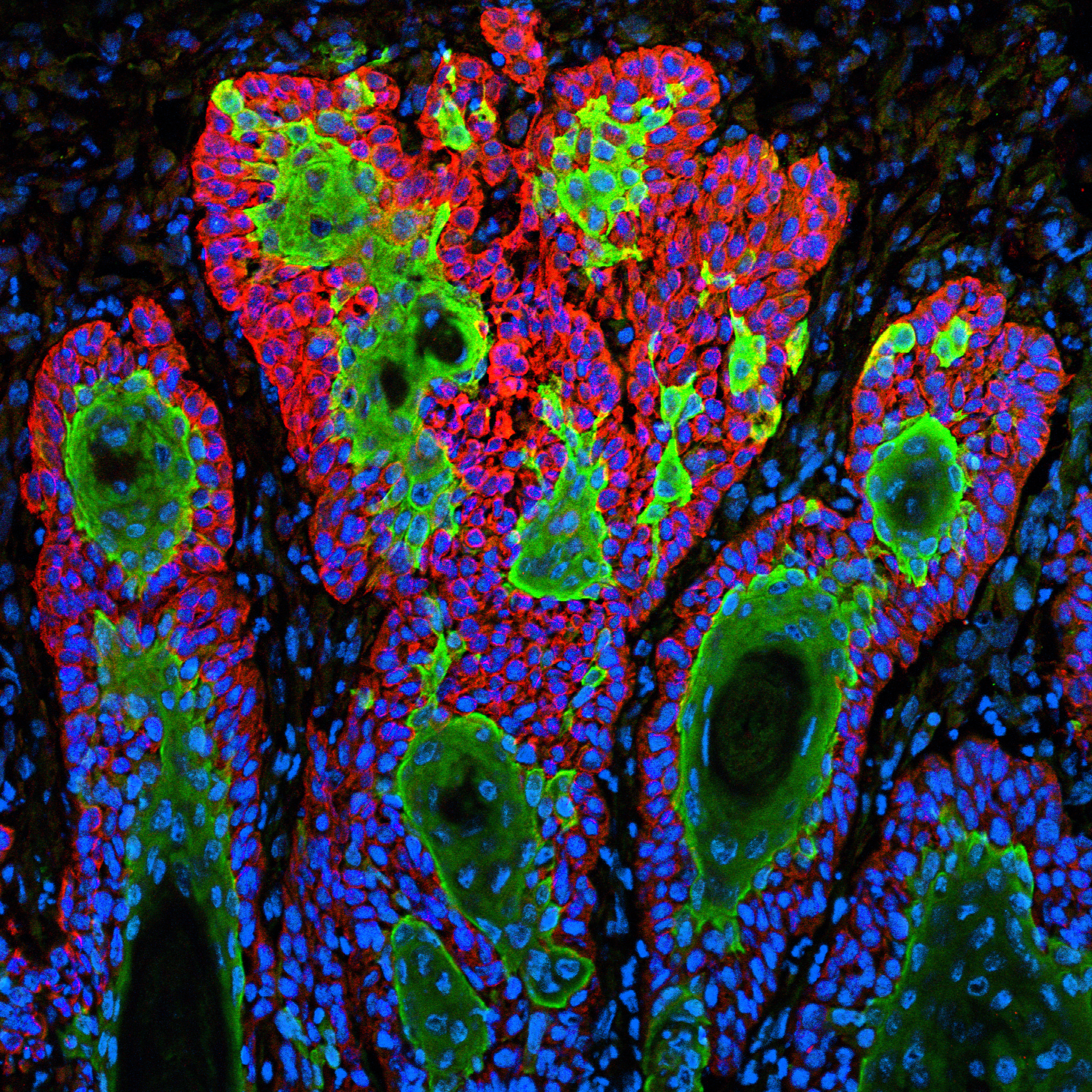 Squamous cell carcinoma, a type of skin cancer