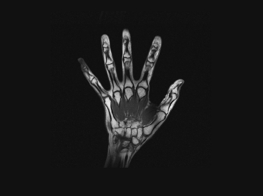 MRI scan of the hand 