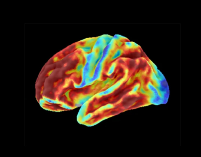 Brain images of a woman with an inherited condition that causes early-onset Alzheimer’s disease show high levels of amyloid plaques (top) but limited tau (bottom) for her age. Blue represents lowest levels and red represents highest. 