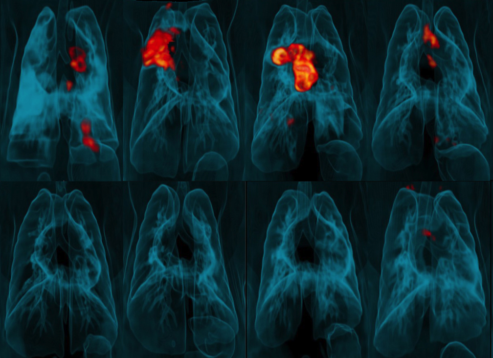 Image of PET-CT lung scans
