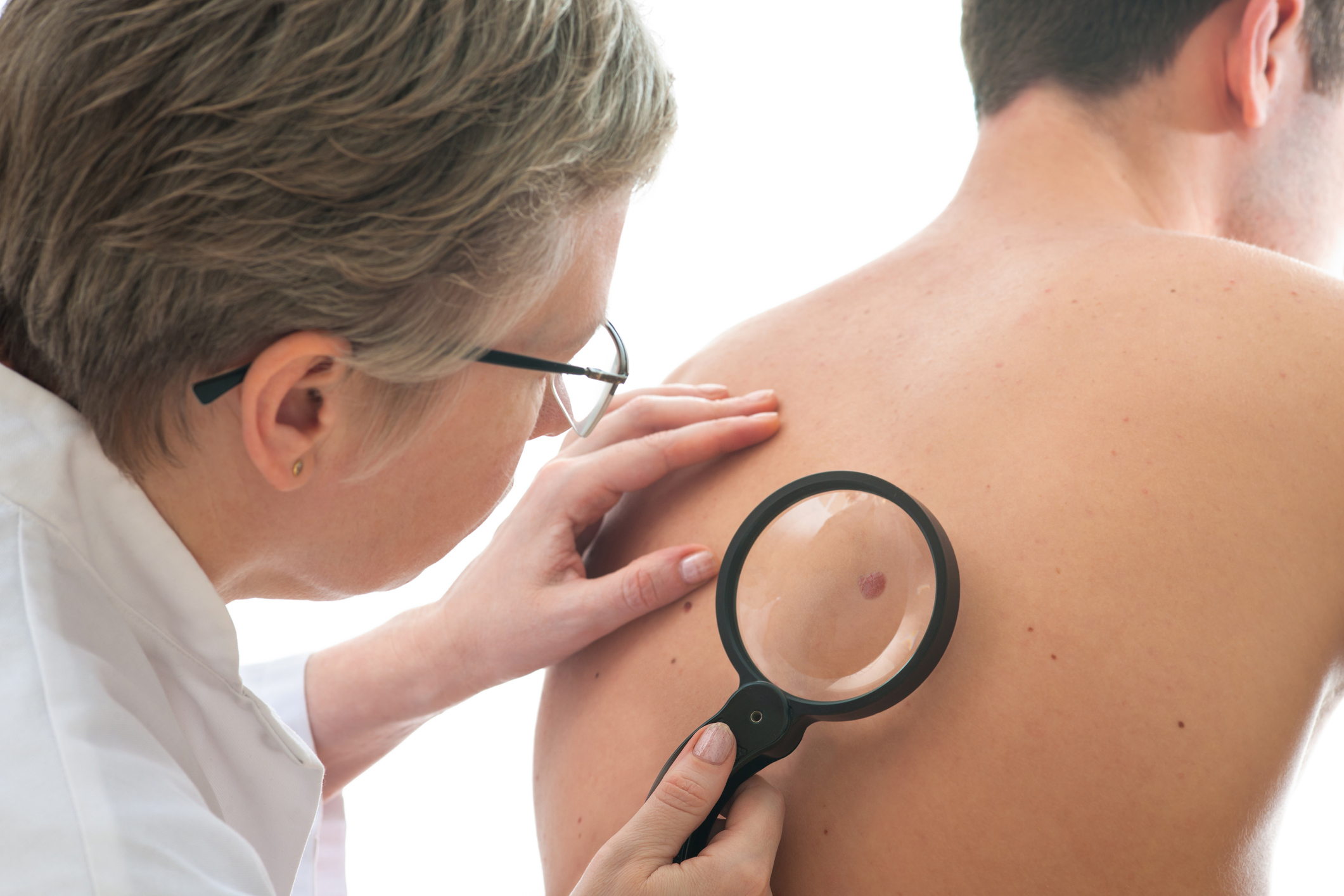 Dermatologist examining a mole on a person’s back