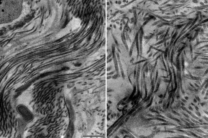 Electron micrographs of scar tissue