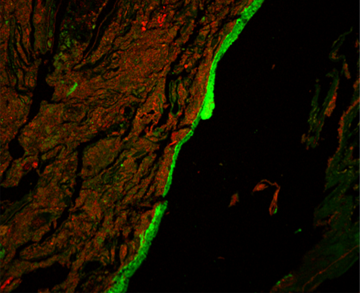 Immunofluorescent image of mucus barrier around red mass