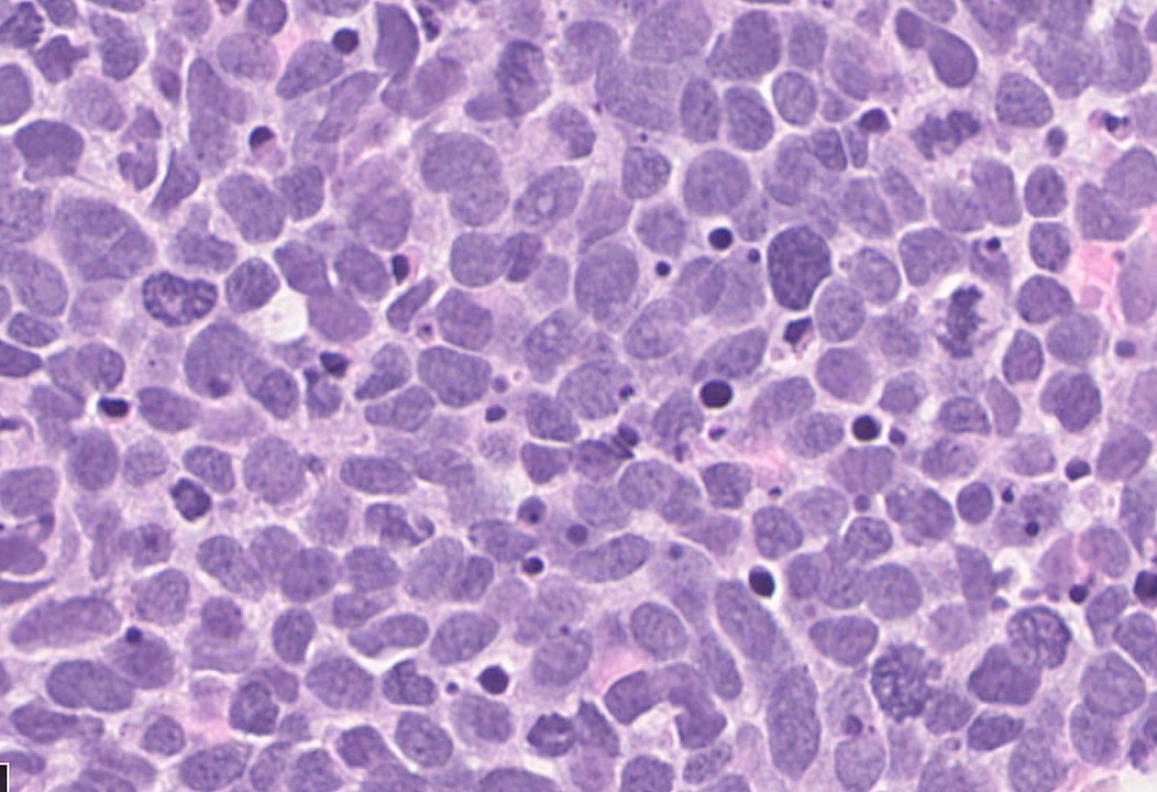 خلايا سرطان الرئة الصغيرة كما تبدو تحت المجهر