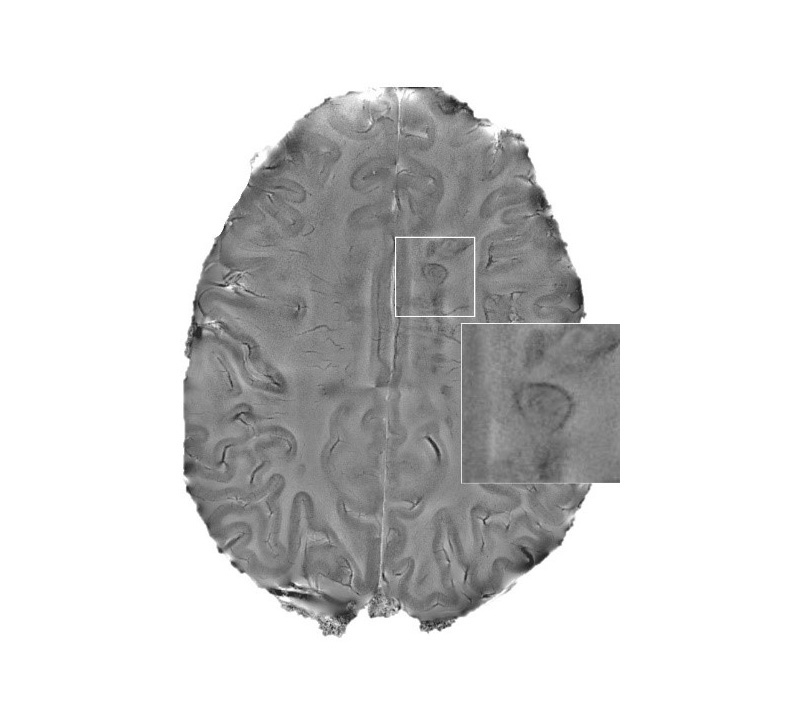 MRI scan of a human brain with multiple sclerosis