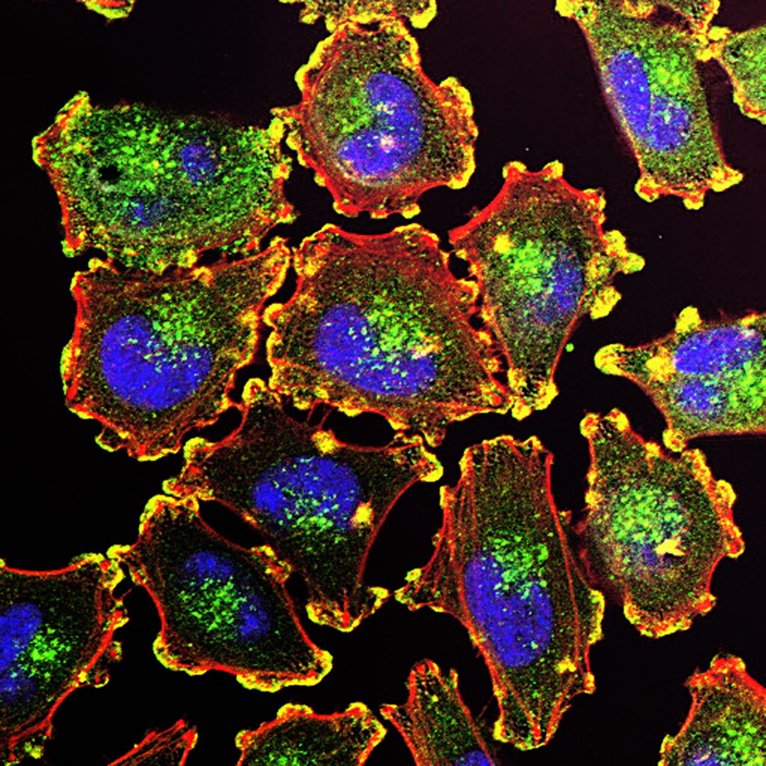 Metastatic melanoma cells