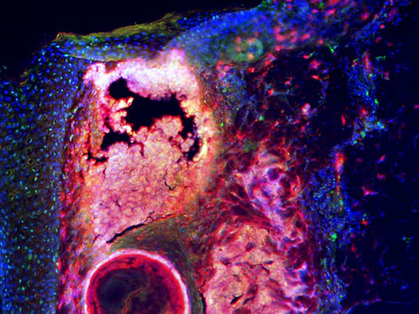 How skin cells help fight acne | National Institutes of Health (NIH)