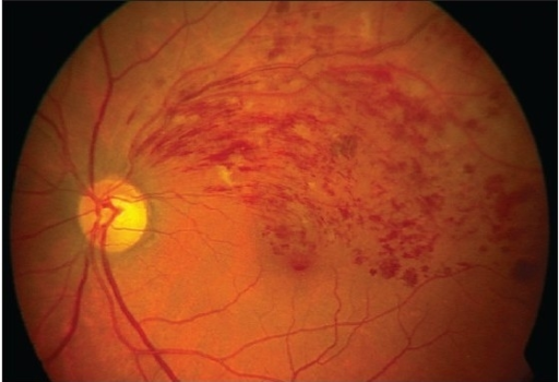 Color fundus photograph of an eye with retinal vein occlusion
