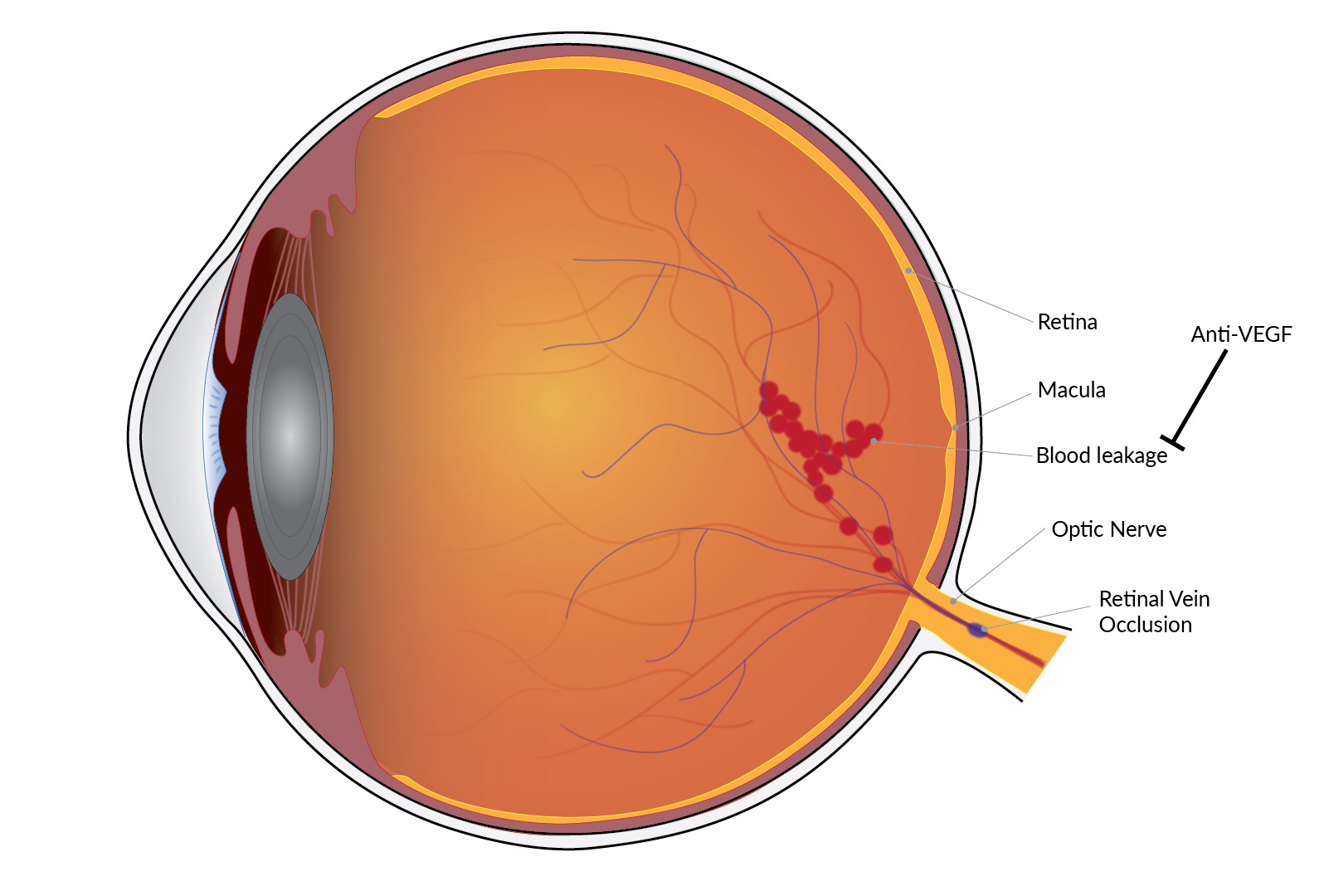 Illustration of the interior of a human eye showing a retinal vein occlusion and leakage from blood vessels.
