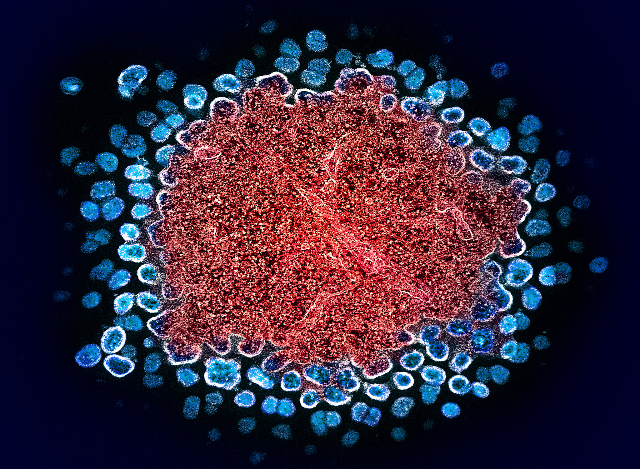 Numerous HIV particles surrounding a cell, with some emerging from it Numerous HIV particles surrounding a cell, with some emerging from it