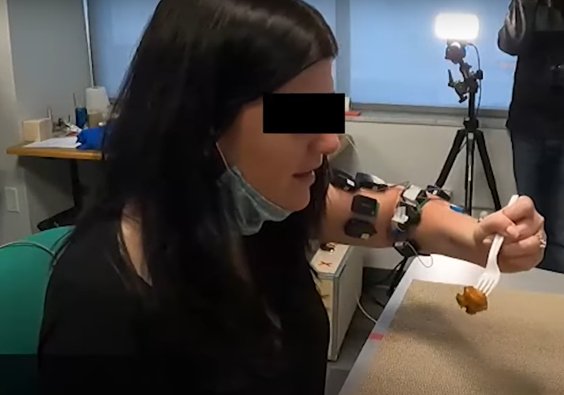 Video shows how woman has trouble eating with a fork before spinal stimulation, but can successfully use the fork to eat with the stimulation on.