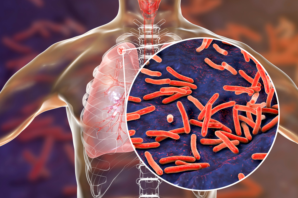 Mycobacterium tuberculosis bacteria in lungs Mycobacterium tuberculosis bacteria in lungs.