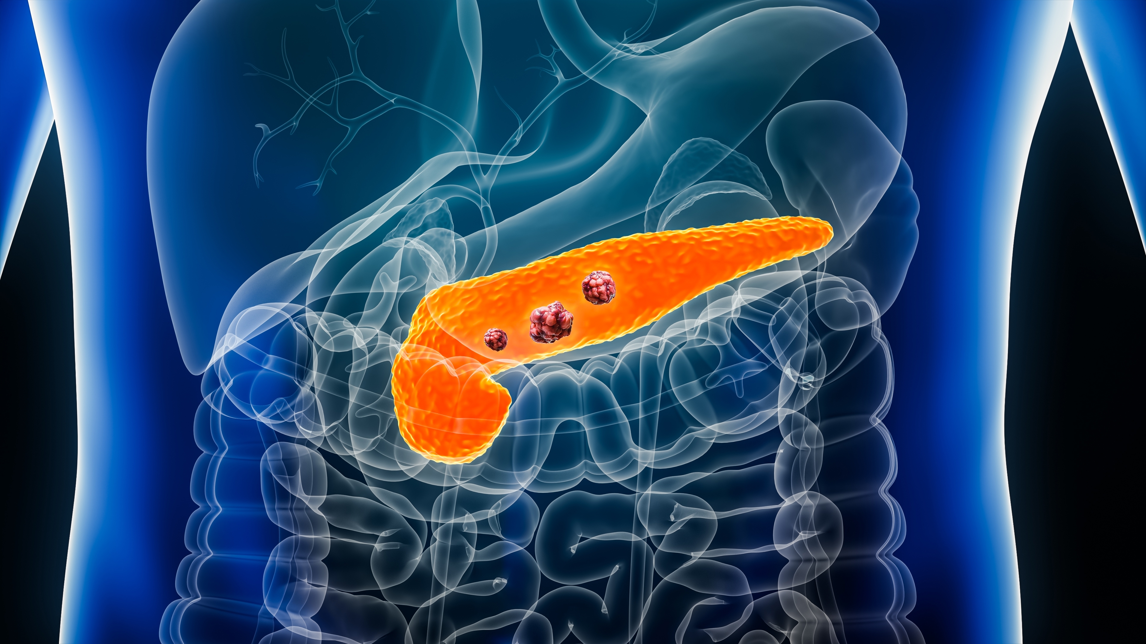 Illustration of pancreas with tumors.