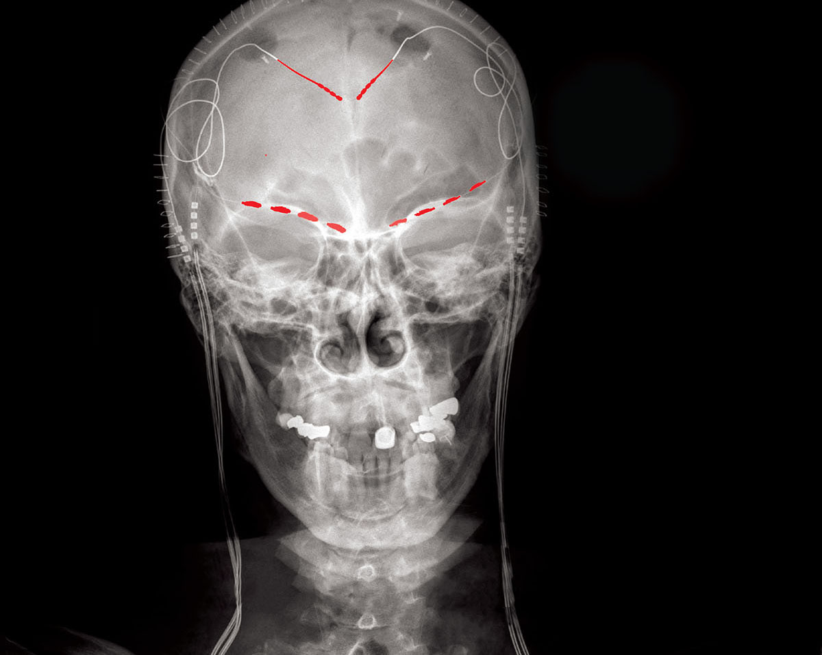 A-ray shows recording devices in both shoulders and electrodes at the top of the brain and above the eye sockets.