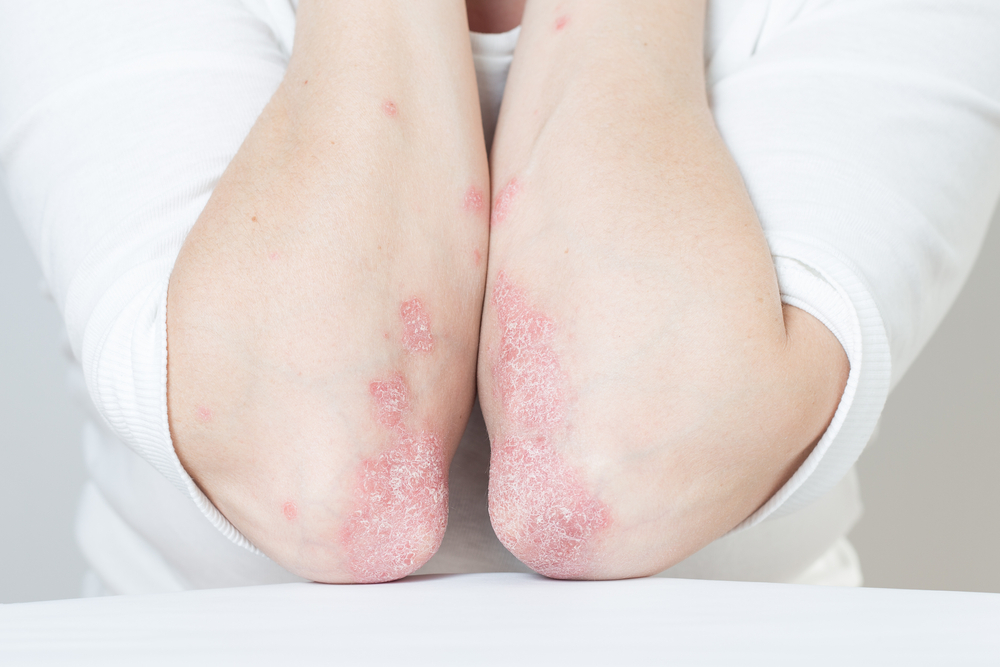 Flaky, red skin on person’s elbows Flaky, red skin on person’s elbows.