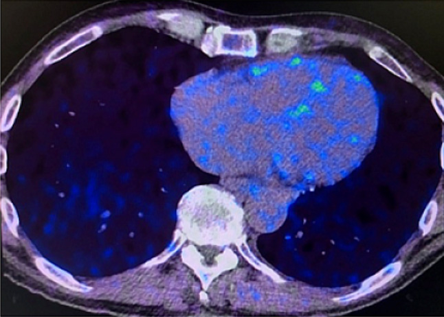 Heart PET scans from a study participant