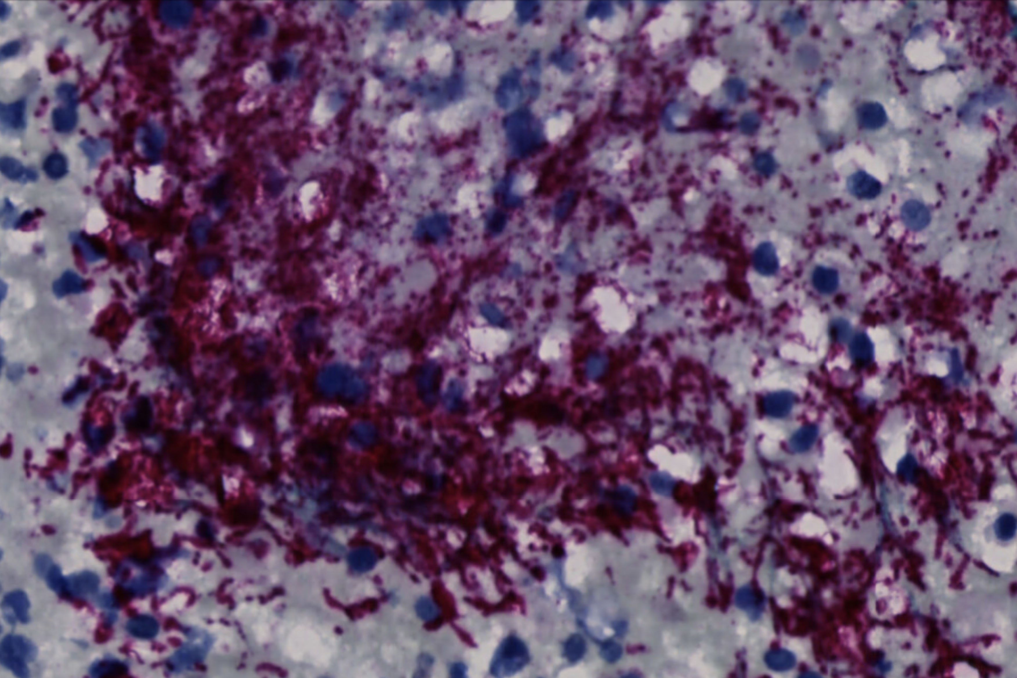 Microscope image of purple-stained bacteria throughout a tumor.