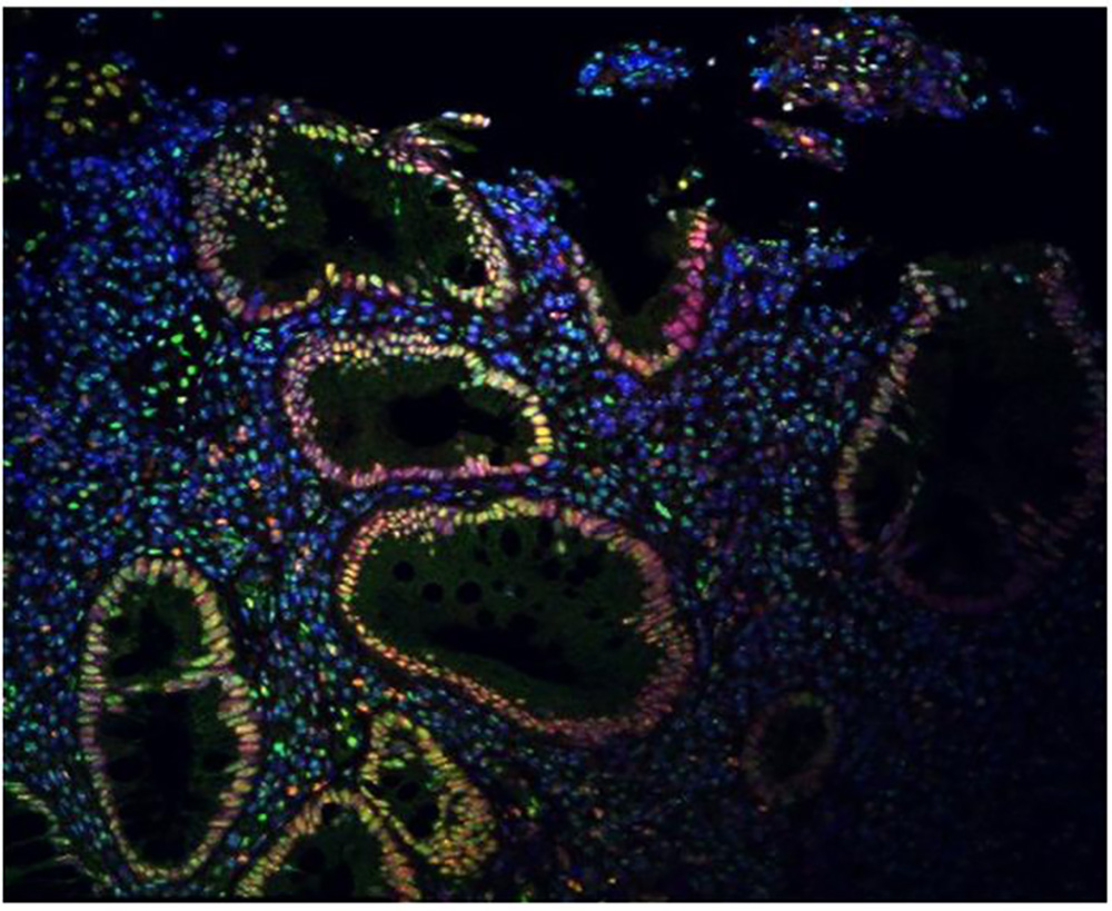 SUMO patterns in colon. Immunofluorescence signal is strong in the epithelial cells surrounding colon spaces.