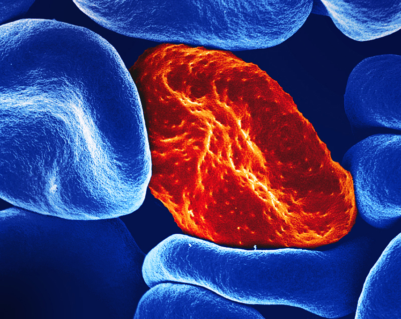 Red blood cell infected with malaria parasites. Colorized scanning electron micrograph of red blood cells. The one infected by malaria parasites has a rough surface, while the others are smooth.