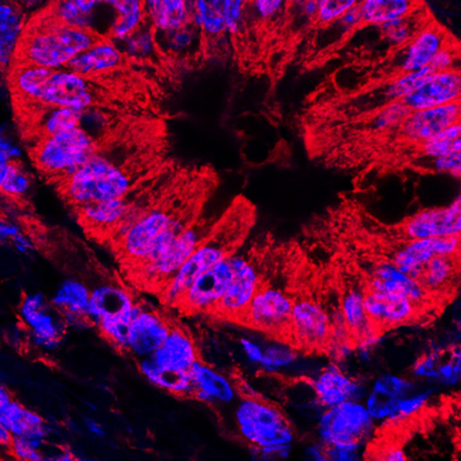 Microscope image of abnormal pancreatic ducts. Microscope image of abnormal pancreatic ducts.