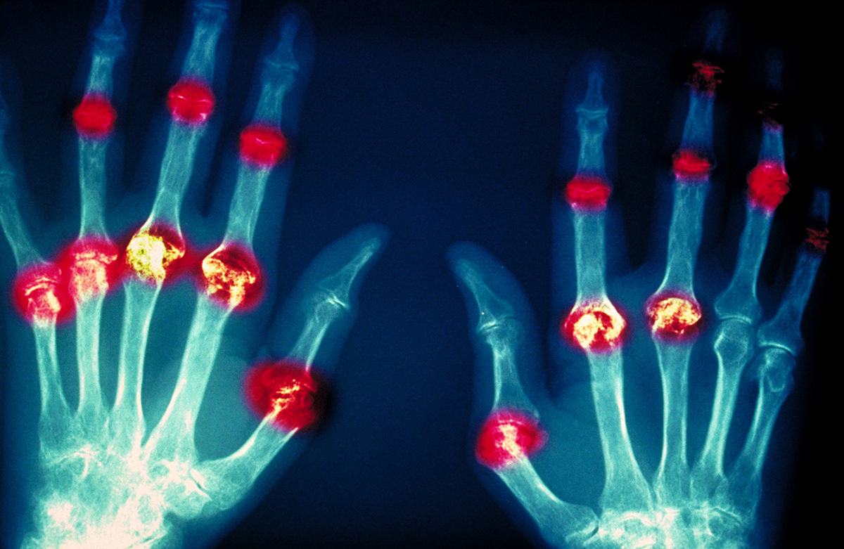 A horizontal X-ray image depicting joint damage from rheumatoid arthritis.