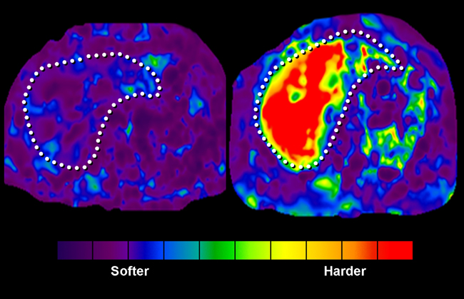 Two liver elastograms.