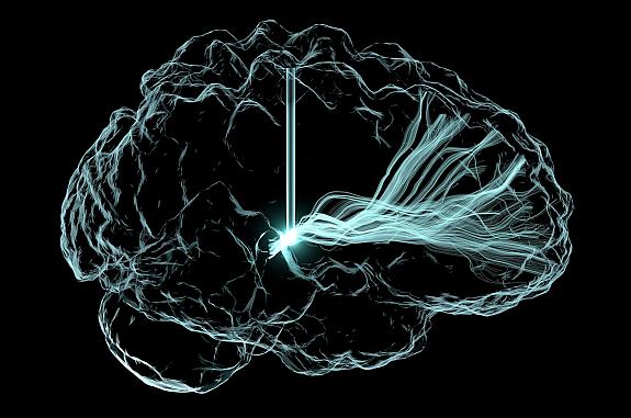 Artistic rendering of deep brain stimulation (DBS), with an outline of brain and vertical lines that represent wire leads with a single electrode that has been inserted deep within the brain to reach a region involved in cognition, the central thalamus.