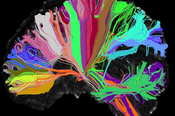 This High Angular Resolution Diffusion Image (HARDI) of the human brain shows long distance connections, or tracts. Wiring associated with particular brain structures share the same color.