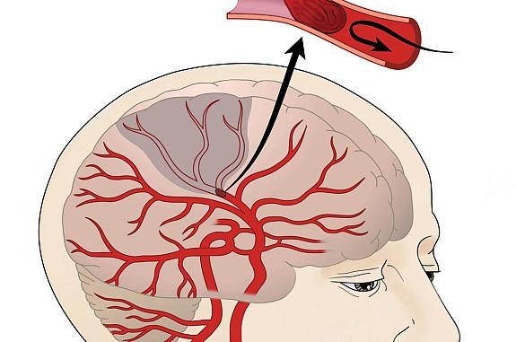 Illustration of an ischemic stroke, which occurs when a brain blood vessel gets blocked. The unblocked blood vessels in the head are represented in red and the blocked vessels in gray. The gray area represents brain tissue that is not receiving nutrients.