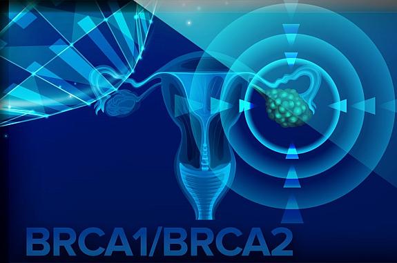 Graphical representation of a uterus and ovaries with BRCA1/BRCA2 labeled on the bottom.