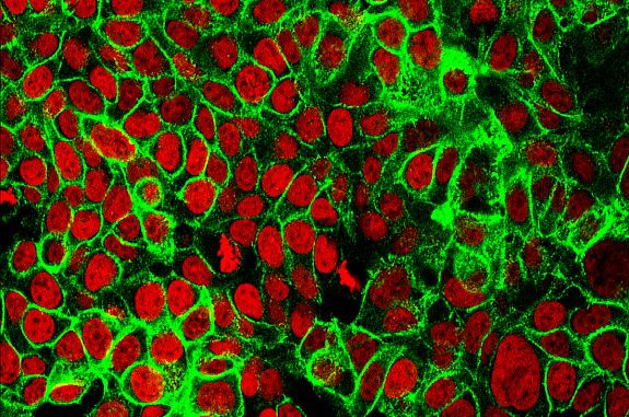 Human colon cancer cells with the cell nuclei stained red and the protein E-cadherin stained green.