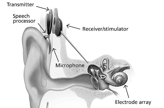 Ear with cochlear implant