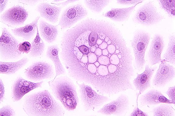 Purple cellular image stain of a koilocyte, a squamous epithelial cell that has undergone structural changes as a result of infection by human papillomavirus (HPV).