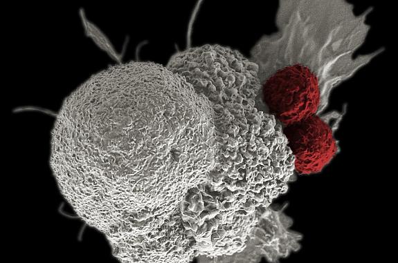 Scanning electron micrograph of an oral squamous cancer cell (white) being attacked by two cytotoxic T cells (red), part of a natural immune response.