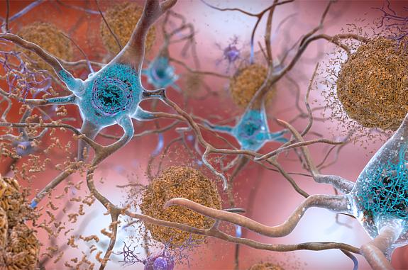 Illustration of amyloid plaques and tau tangles, colored in brown, surrounded by brain cells, colored in cyan and purple.