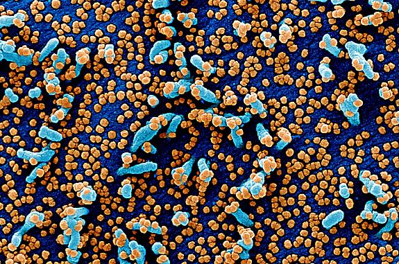 Colorized scanning electron micrograph of a blue colored cells heavily infected with SARS-COV-2 virus particles shown in orange.