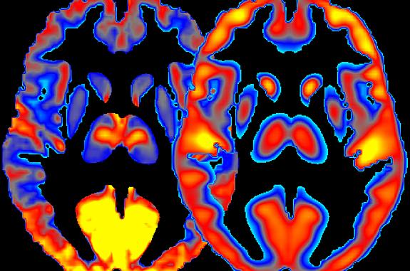 Brain images showing brain activity and glucose consumption