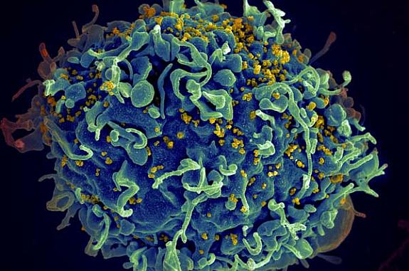 Human cell with HIV viruses on surface