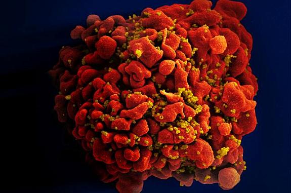Scanning electron micrograph of an HIV-infected T cell.