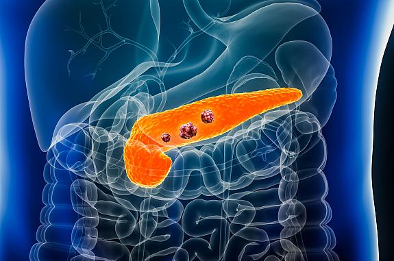 Illustration of pancreas with tumors.