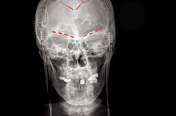 A-ray shows recording devices in both shoulders and electrodes at the top of the brain and above the eye sockets.