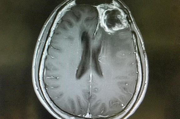 MRI of a gliblastoma.